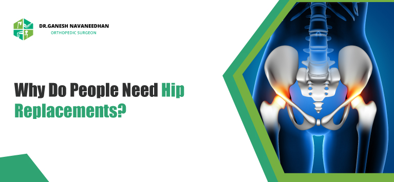 Why Do People Need Hip Replacements?