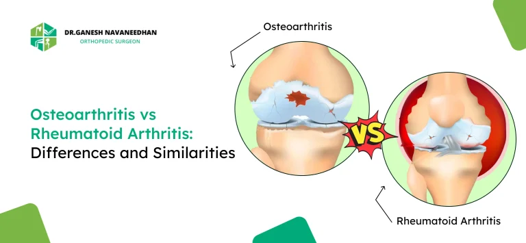 Osteoarthritis vs Rheumatoid Arthritis