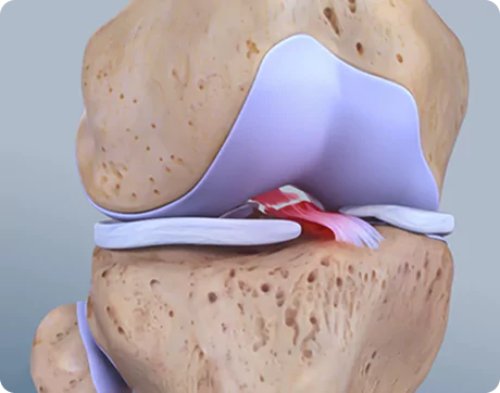 Anterior cruciate ligaments (ACL)