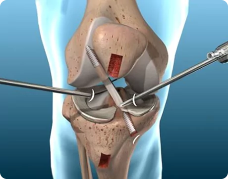 Arthroscopy