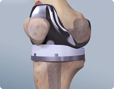 Revision Knee replacement surgery