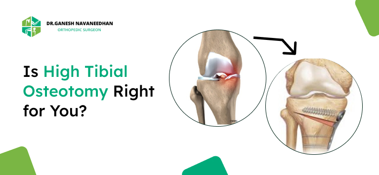 High Tibial Osteotomy