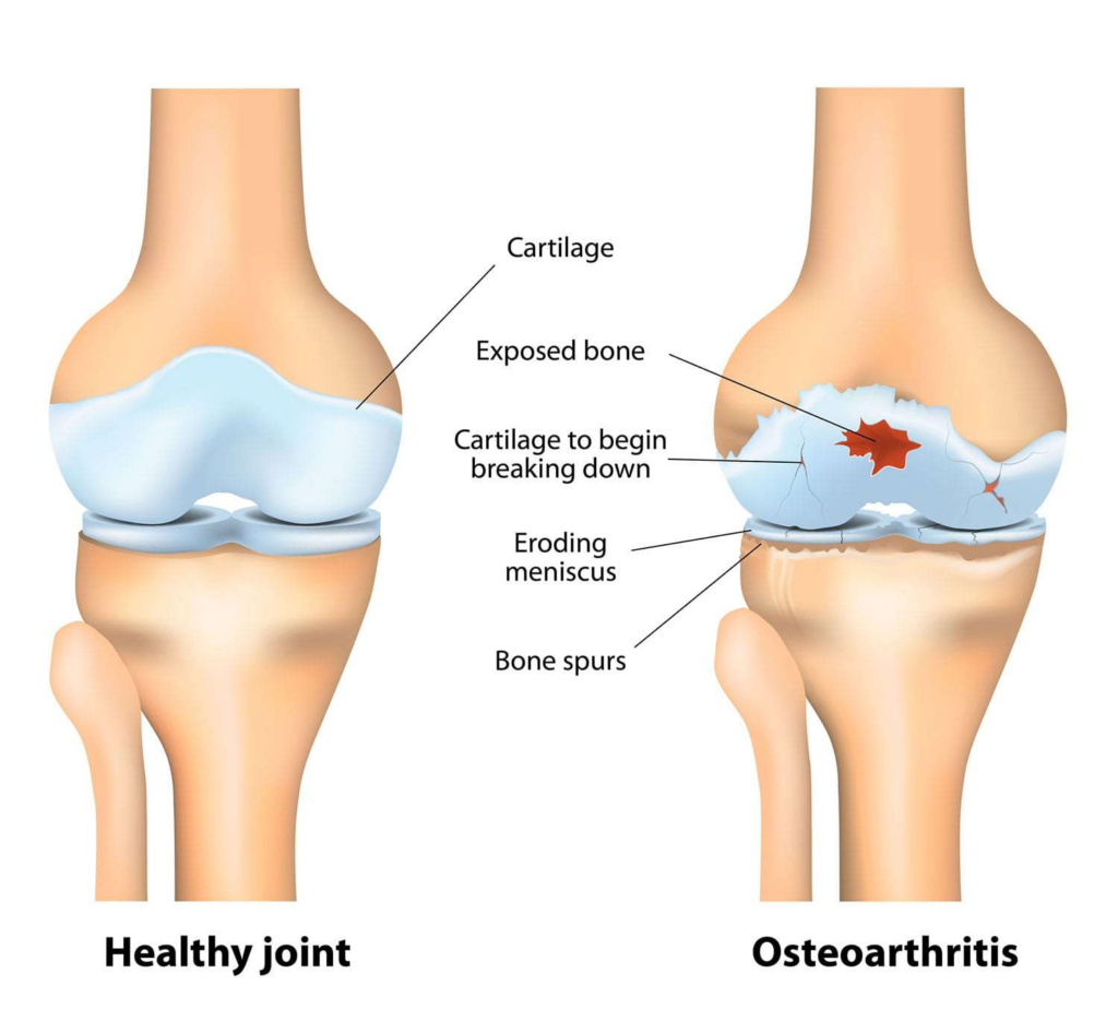 Is Osteoarthritis an Autoimmune Disease