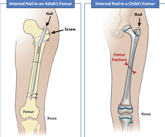 Recovery Time for Broken Femur with Rod