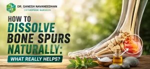 How to Dissolve Bone Spurs Naturally